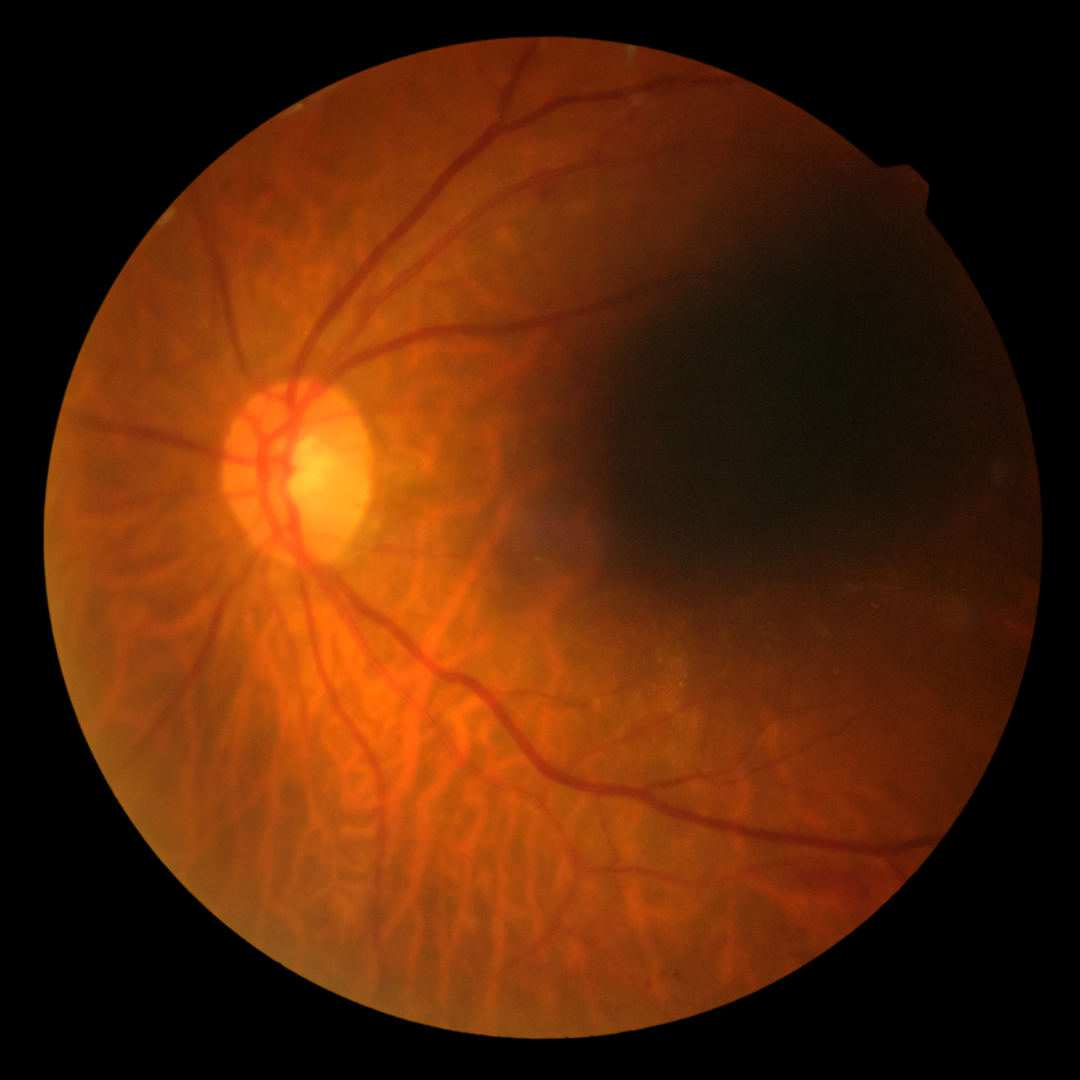 Penglihatan-Tiba-tiba-Kabur-Bisa-Jadi-Central-Serous-Retinopathy.png